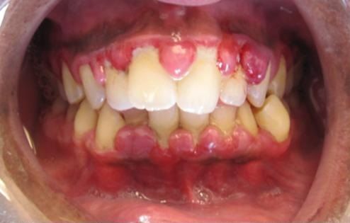 Dental doldrums in Denmark: Bad teeth costs jobs