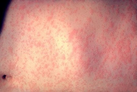 Measles on the rise again in Europe