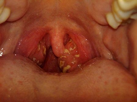 Taking tonsils out can lead to serious problems later, Danish study indicates