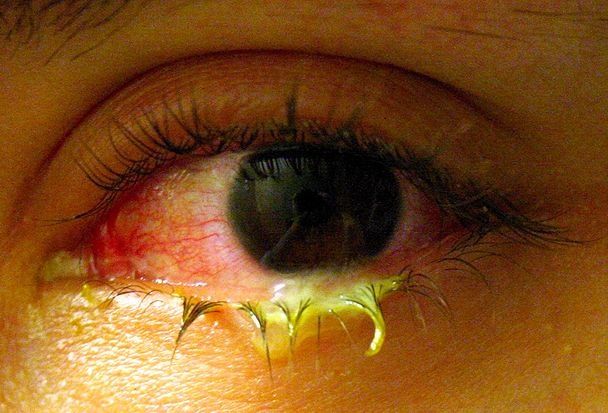 Let nature take its course when it comes to most eye infections, researchers urge
