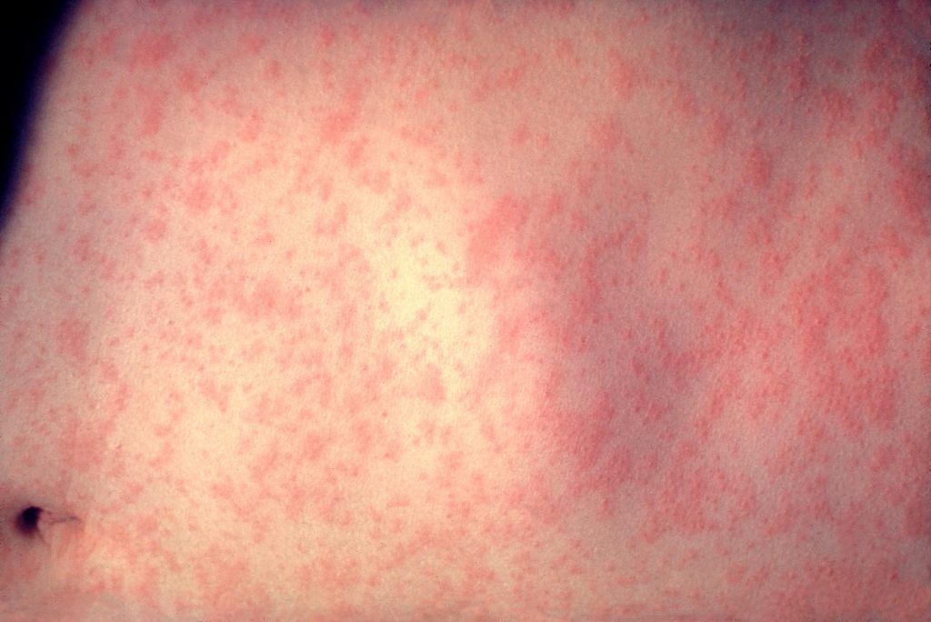 Possible measles scare in Copenhagen Airport