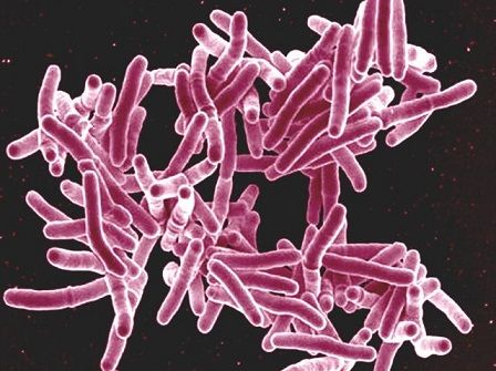Five cases of multi-resistant TB found in Denmark this year