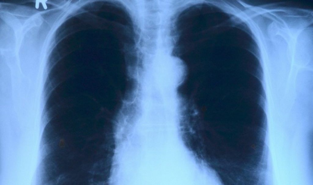 Danish hospital employee may have infected hundreds with tuberculosis